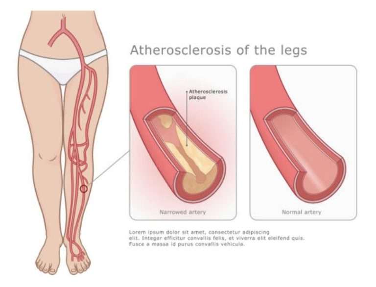 Peripheral Arterial Disease Pittsburgh PA